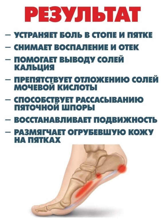 Лечение шпоры в самаре. Препараты для обезболивания пяточной шпоры. Лечение шпоры в самаре. Шпора на пятке чем лечить. Процедуры при пяточной шпоре.