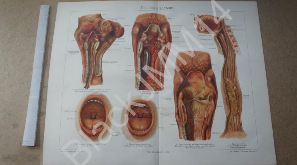 1902 г. Литография Горловые болезни Дифтерит Полип Отек Опухоль